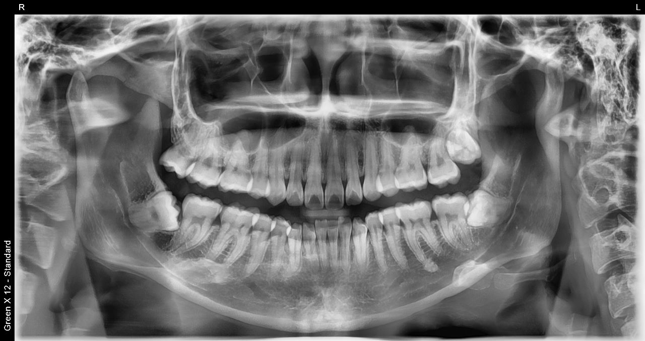 Tomógrafo Dental Vatech Green X12 - Radiografía Panorámica